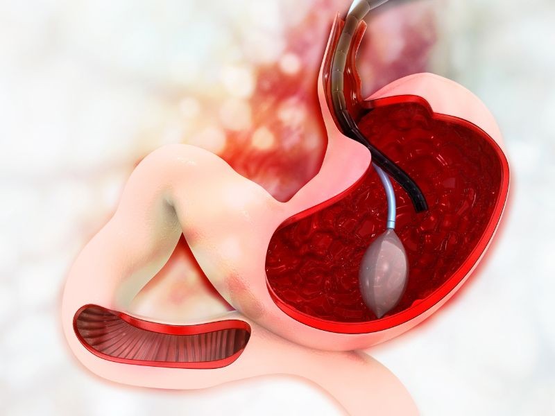 Balão Intragástrico Deglutível